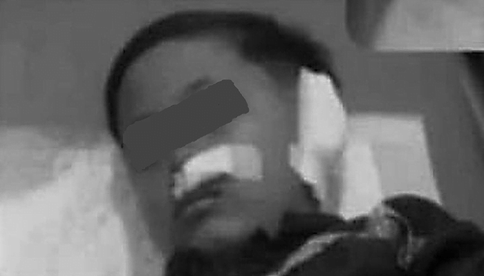 Anak Gigit Telinga Temannya Sampai Putus Diproses Polisi