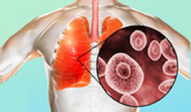 Indonesia Perlu Waspadai Penyakit Pneumonia